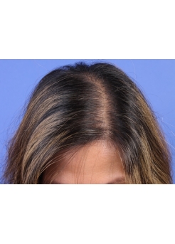 Before Hair Transplant&nbsp;Hair Thinning
